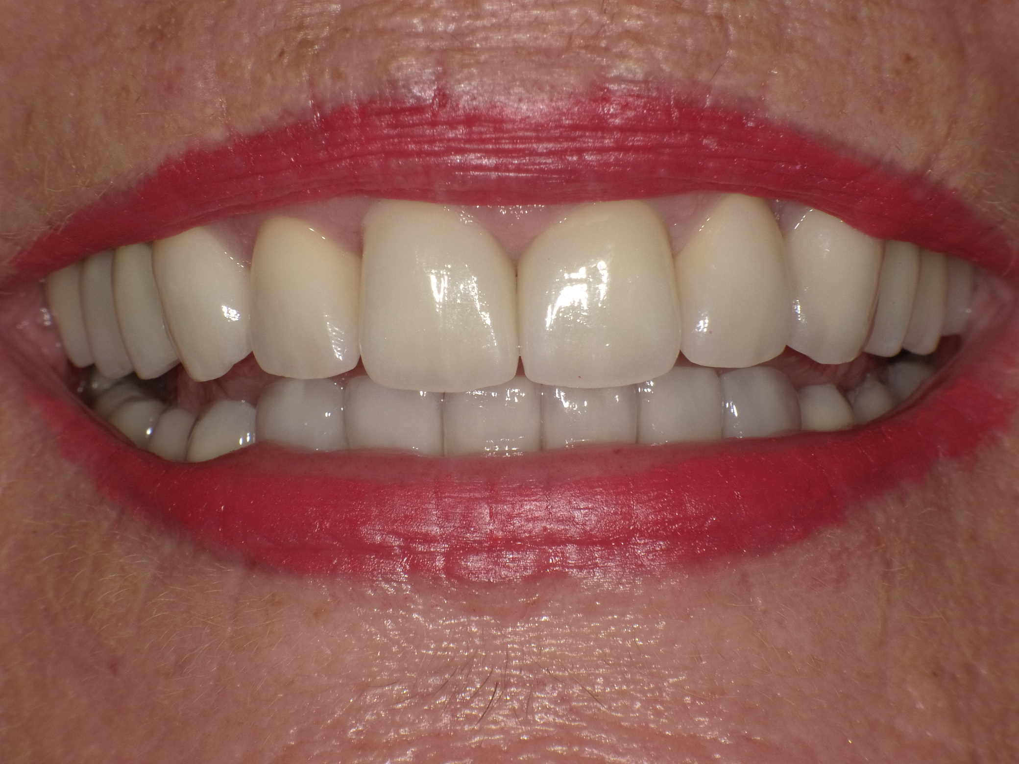 Komplettbehandlung in nur 2 Terminen mit Veneers und Keramikkronen; Behandlung des Angstpatienten unter Sedierung